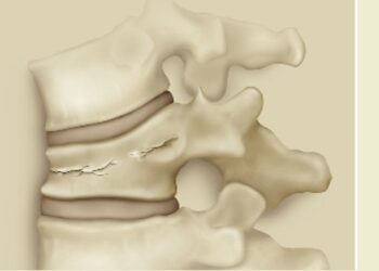 Hoy es el Día internacional de la Osteosporosis