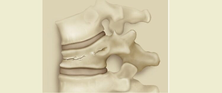 Hoy es el Día internacional de la Osteosporosis