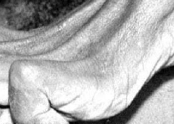 Los Fenómenos cadavéricos tempranos refiere a  la rigidez cadavérica o rigor mortis