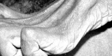 Los Fenómenos cadavéricos tempranos refiere a  la rigidez cadavérica o rigor mortis