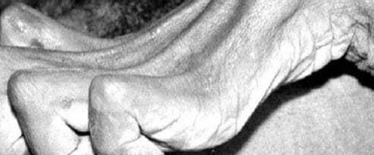 Los Fenómenos cadavéricos tempranos refiere a  la rigidez cadavérica o rigor mortis
