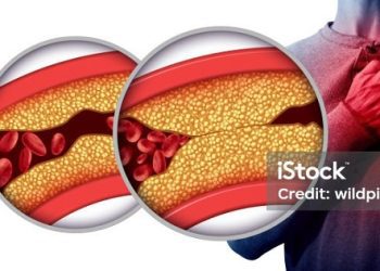 Una pastilla contra el colesterol demuestra que podría reducir el riesgo de infartos y derrames cerebrales