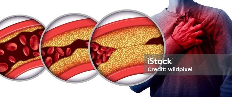 Una pastilla contra el colesterol demuestra que podría reducir el riesgo de infartos y derrames cerebrales