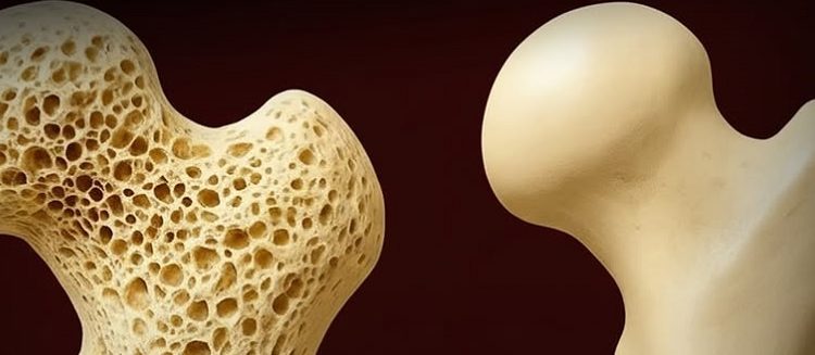 Científicos descubren una nueva manera de fortalecer los huesos y prevenir la osteosporosis