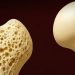 Científicos descubren una nueva manera de fortalecer los huesos y prevenir la osteosporosis